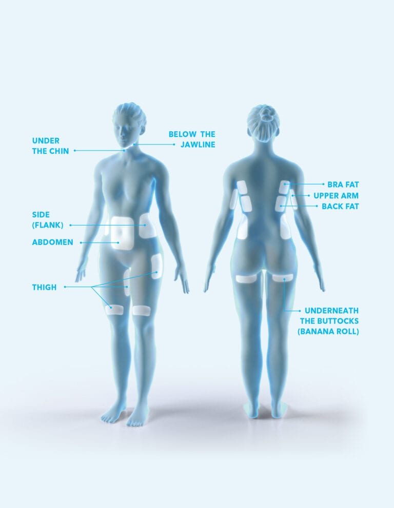 Areas we treat for our Atlanta CoolSculpting patients