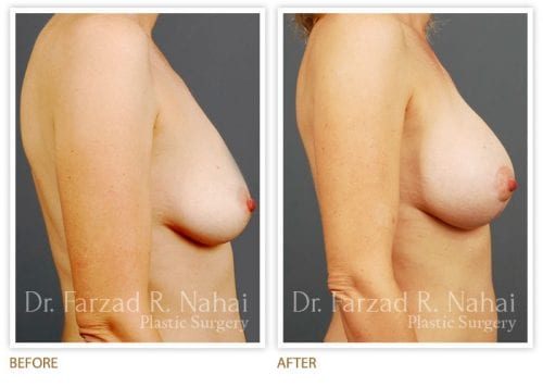 Atlanta breast augmentation before-and-after photo #4
