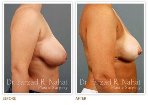 Atlanta breast augmentation before-and-after photo #8