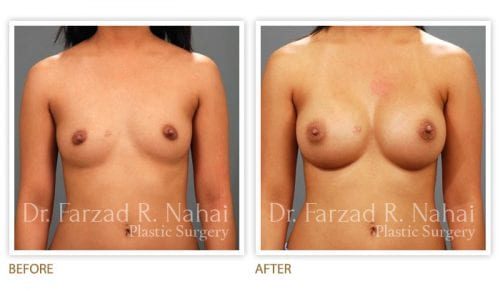 Atlanta breast augmentation before-and-after photo #9