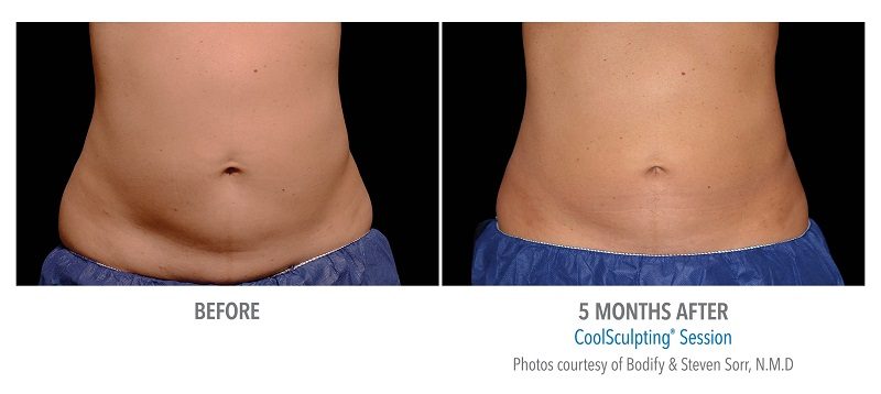 Atlanta CoolSculpting before-and-after photo #2