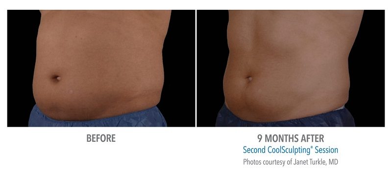 Atlanta CoolSculpting before-and-after photo #7