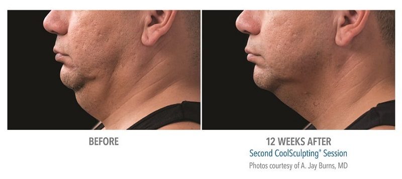 Atlanta CoolSculpting before-and-after photo #9