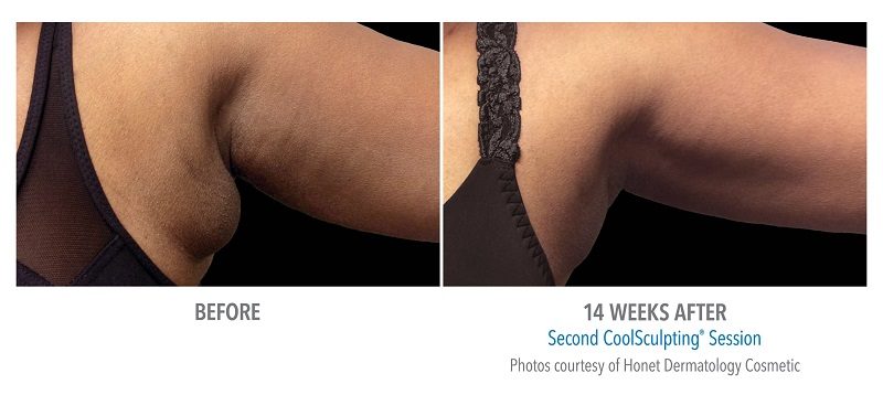 Atlanta CoolSculpting before-and-after photo #10