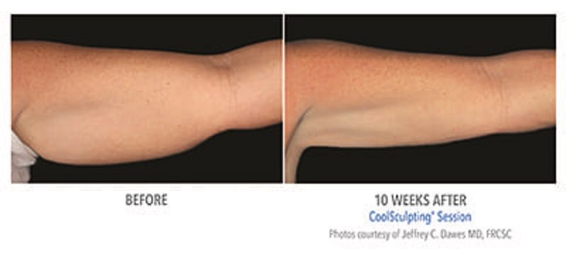 Atlanta CoolSculpting before-and-after photo #11