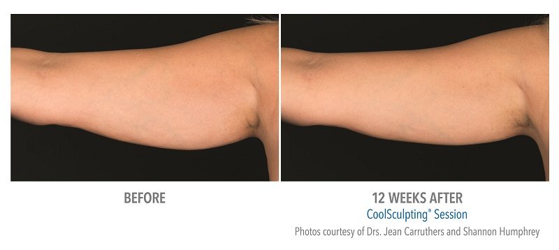 Atlanta CoolSculpting before-and-after photo #12